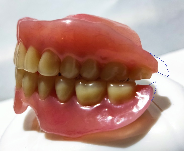 dentures-nausea-rework-full-side-view.jpg