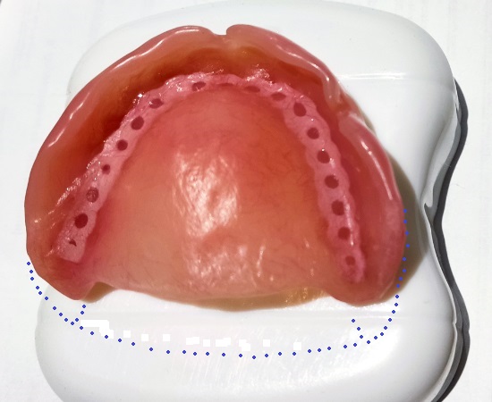 dentures-nausea-rework-up-hi-view.jpg